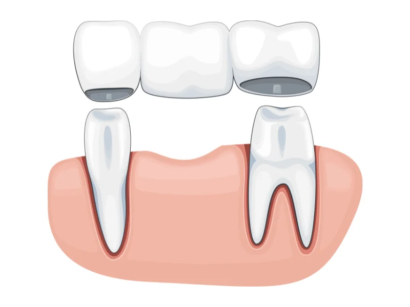 Dental bridges replace one or more missing teeth by anchoring a false tooth (pontic) to the surrounding natural teeth.